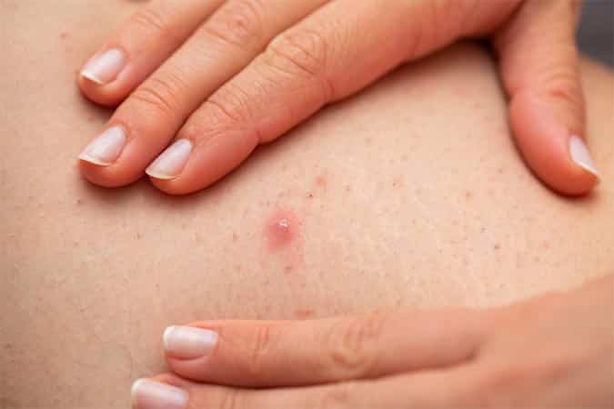 Large Pimple On Inner Thigh, You can get a cortisone shot to make