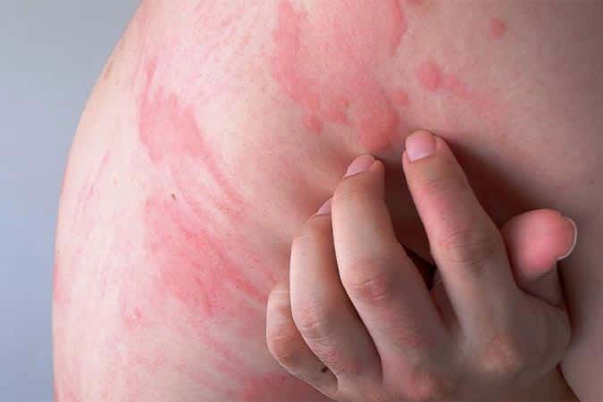 Hives 101: What You Need to Know - Buckhead Dermatology