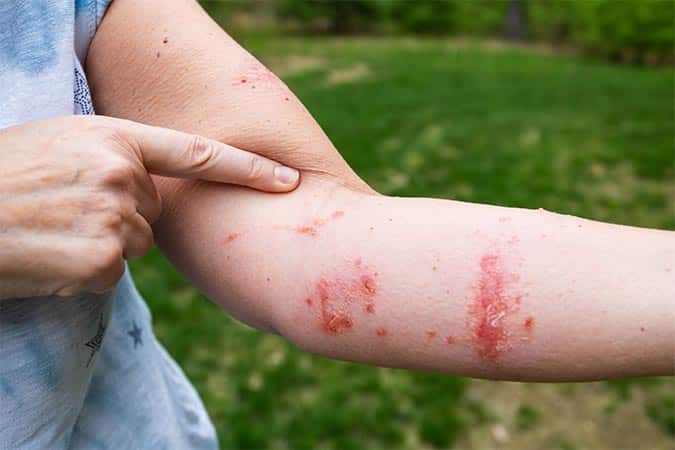 allergic contact dermatitis poison ivy