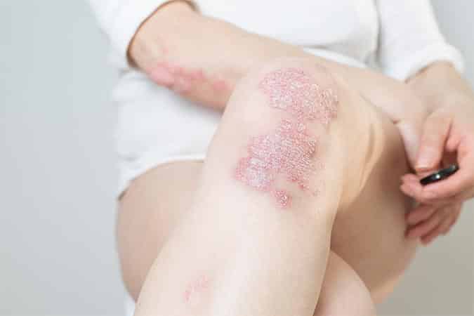 Best Psoriasis Treatment Near Me Marlton NJ South Jersey