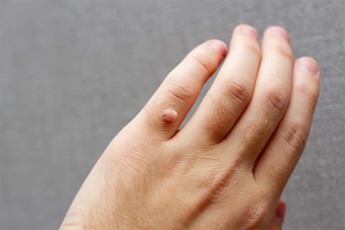 warts on hands treatment